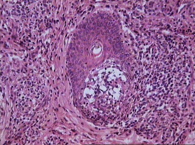 Fig.8  Epidermotropismo - <div style=